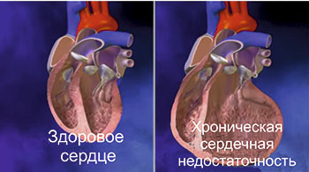 Сердечная недостаточность